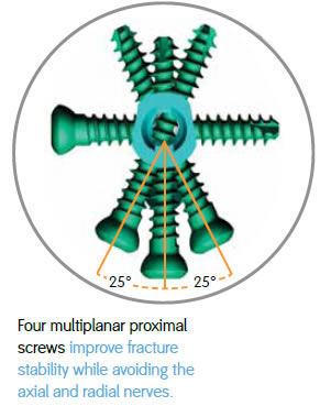 four multiplanar proximal screws